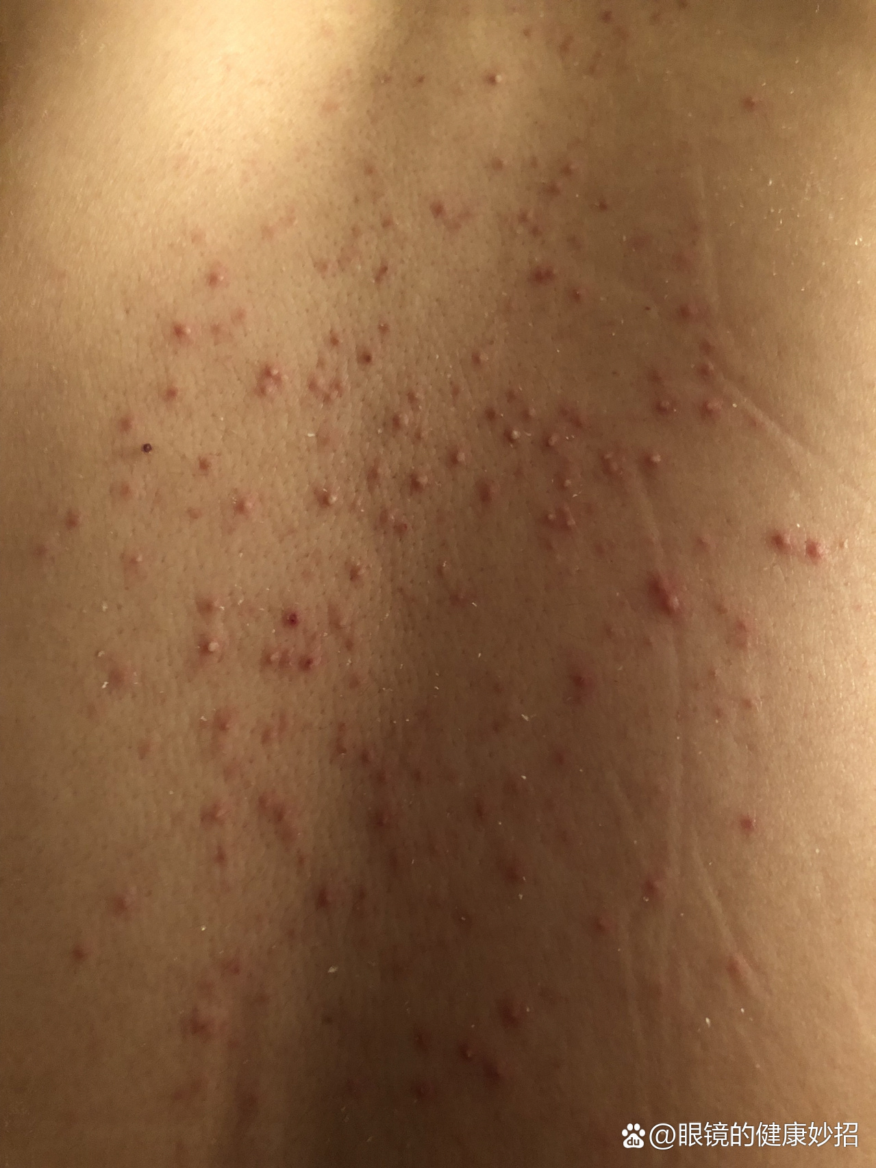 糠秕孢子性毛囊炎