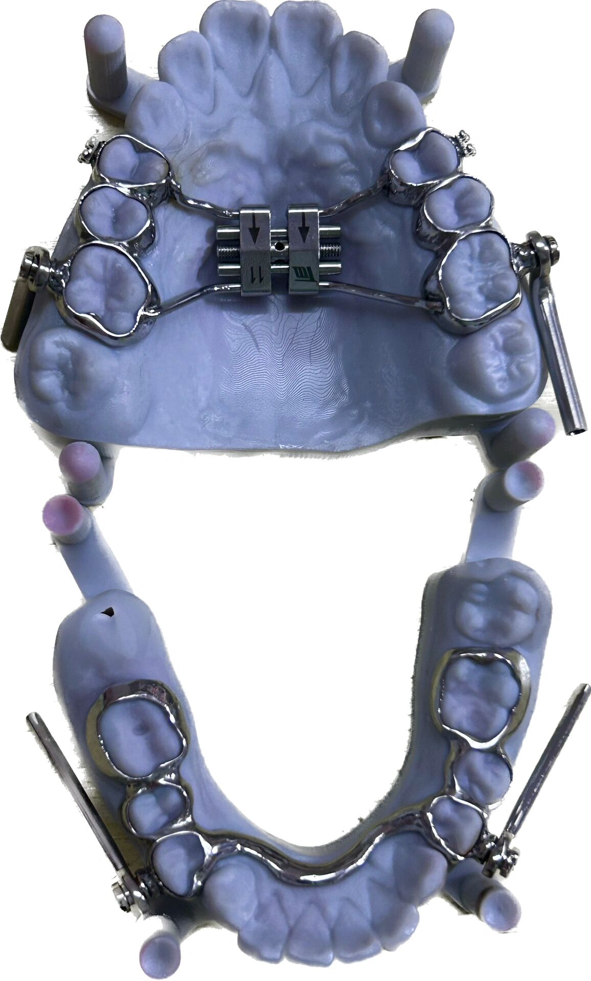  p>herbst 咬颌前移器(导下颌向前) br>herbst矫治器,是一种固定的