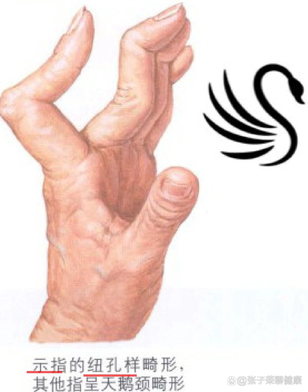 临床病例|一个非常典型的天鹅颈手|类风湿