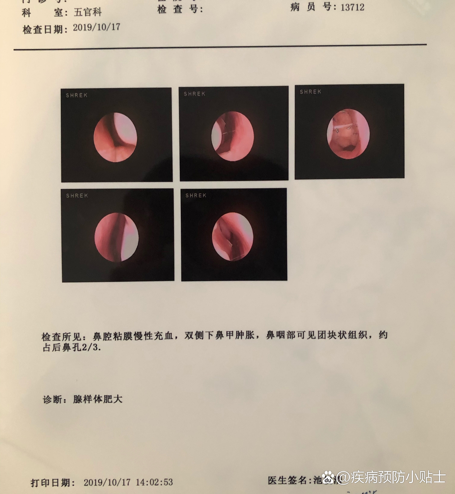 "腺样体肥大"的一二事