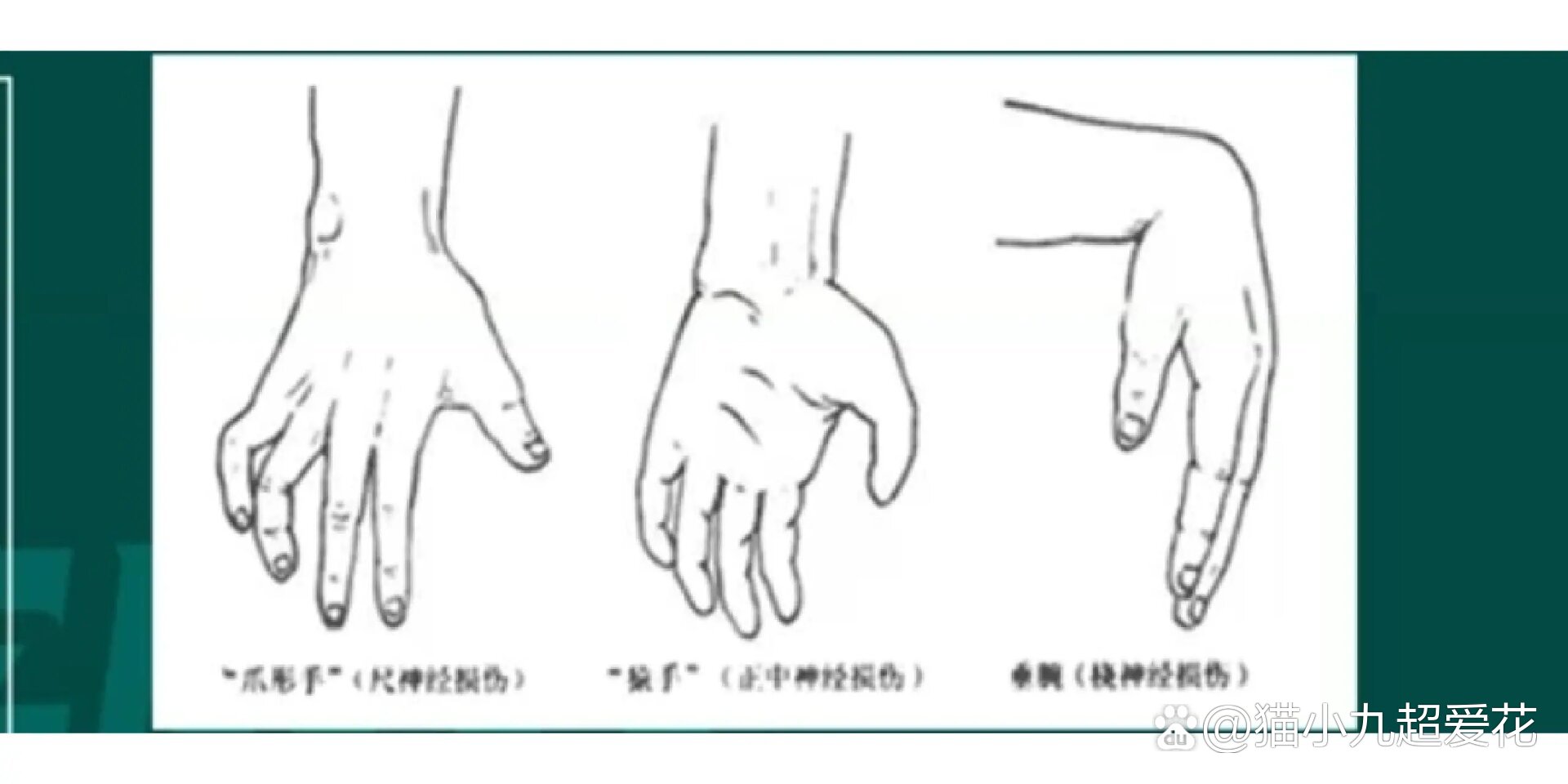  br>尺神经损伤→爪形手 br>正中神经损伤→猿形手 br>桡神经损伤