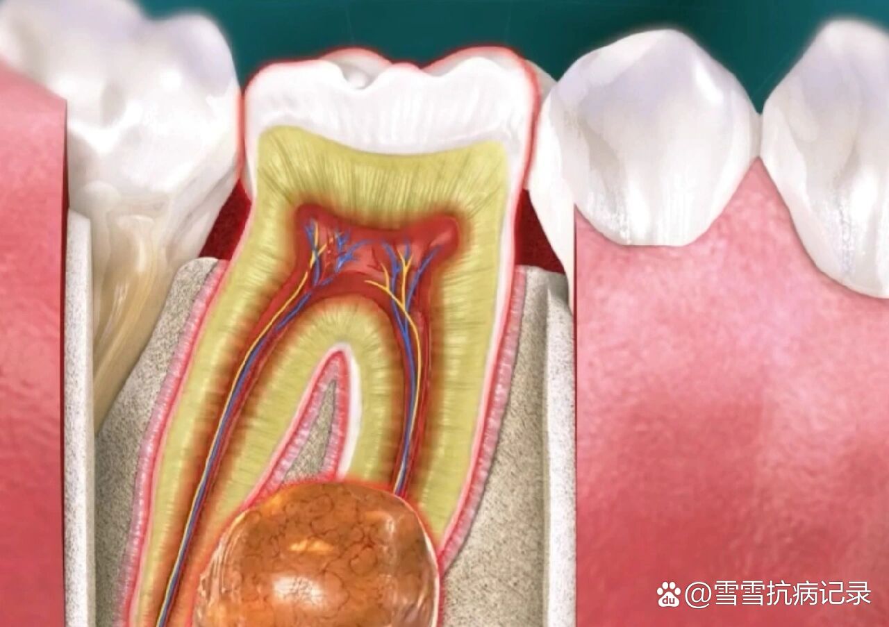 牙根囊肿怎么办图片