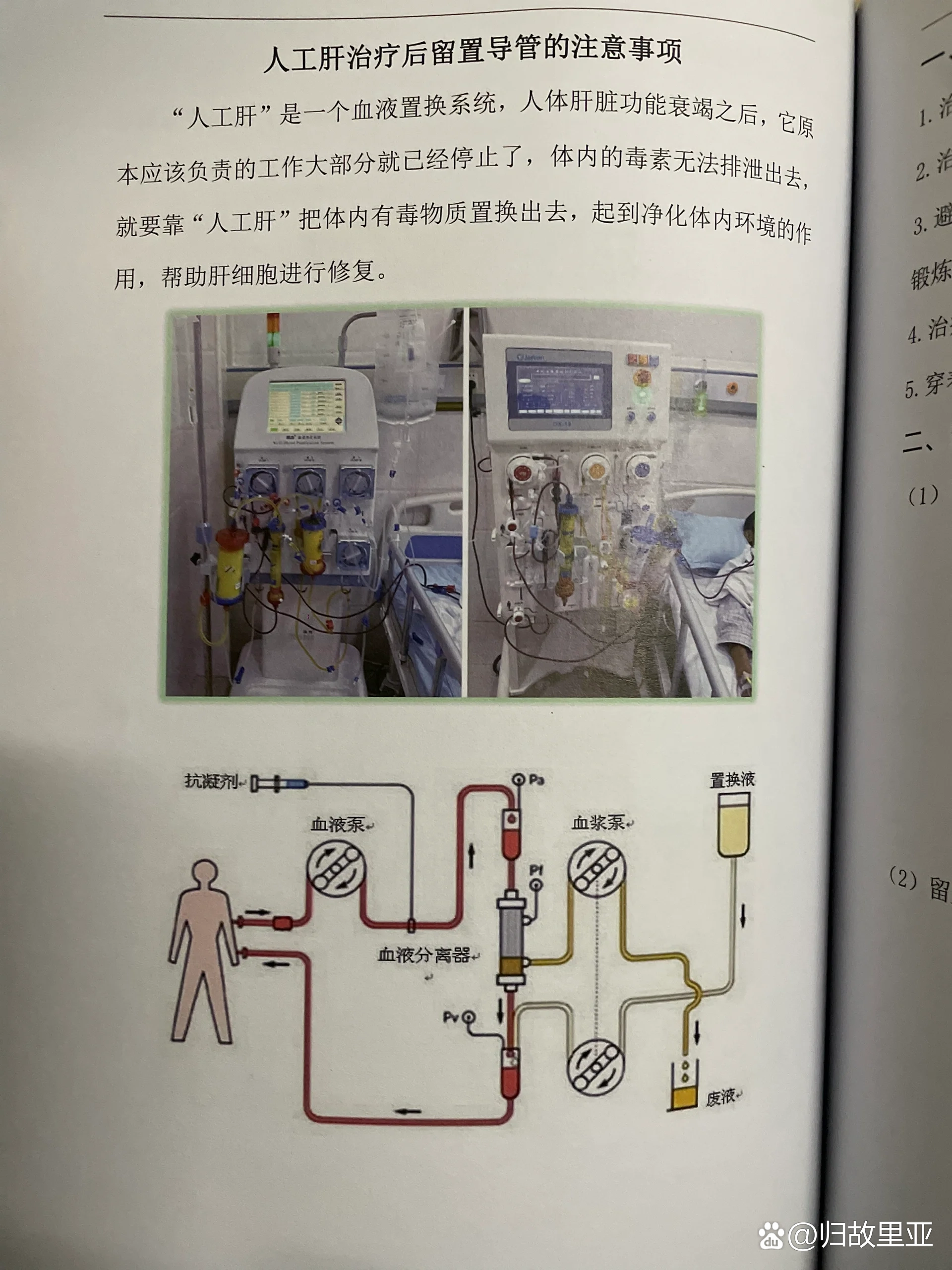 MARS人工肝图片