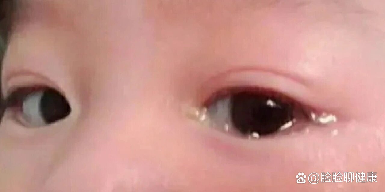 泪囊炎形成的原因和护理在护理新生儿期,常看见一些宝宝眼泪汪汪