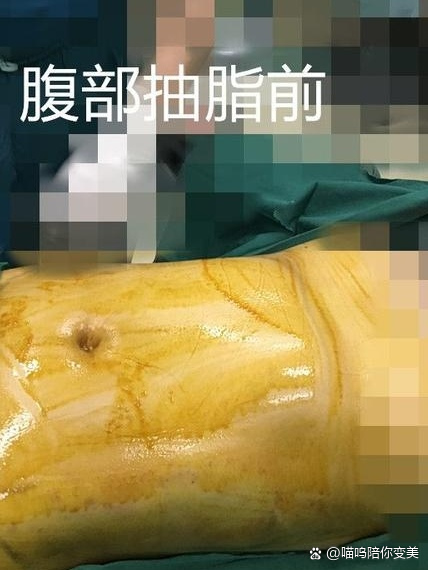 腰腹环吸多久恢复图片