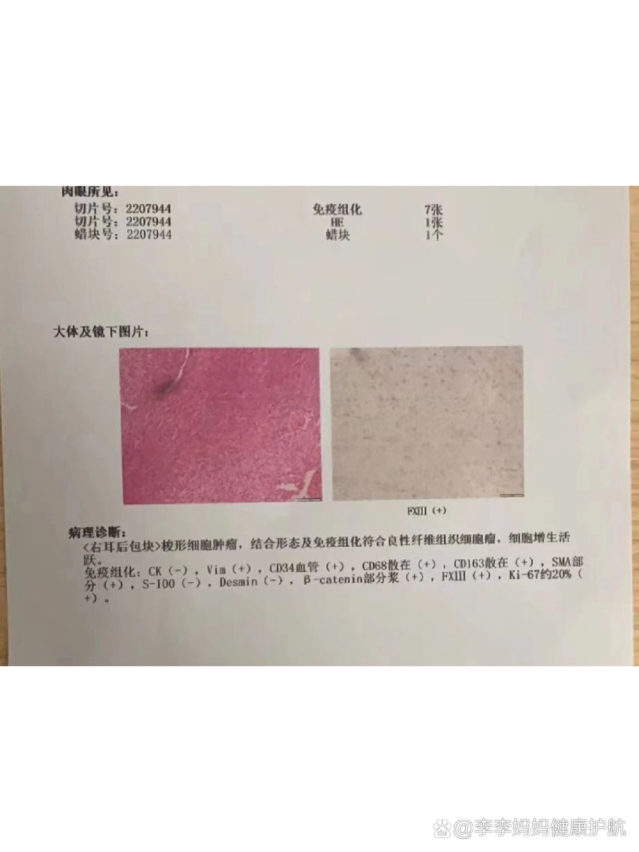 梭形细胞瘤,希望结果不再反转