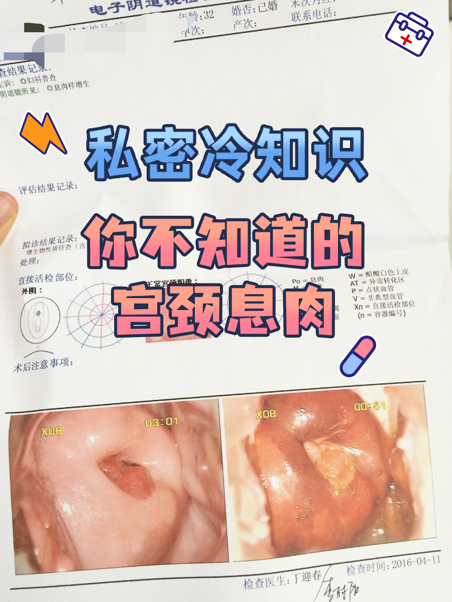 宫颈息肉长啥样照片图片