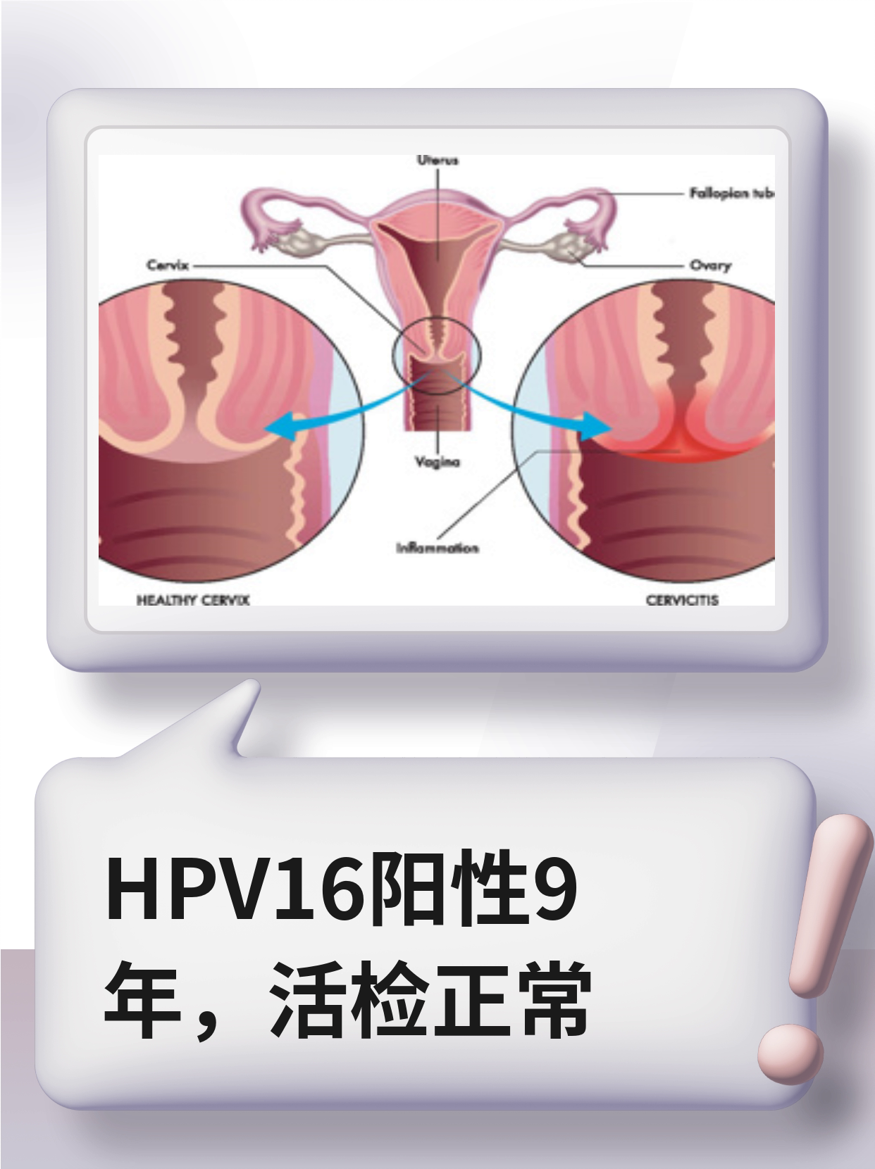  p>"我最近去做体检,查出hpv16阳性,96但我去年做的宫颈活检是正常