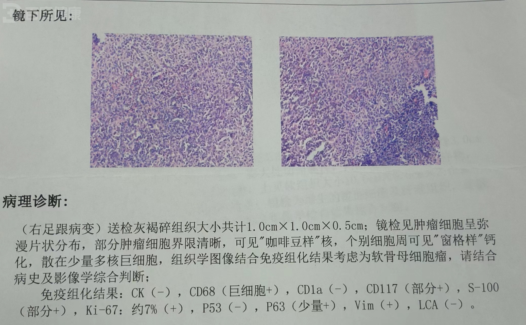 软骨母细胞瘤病例分享