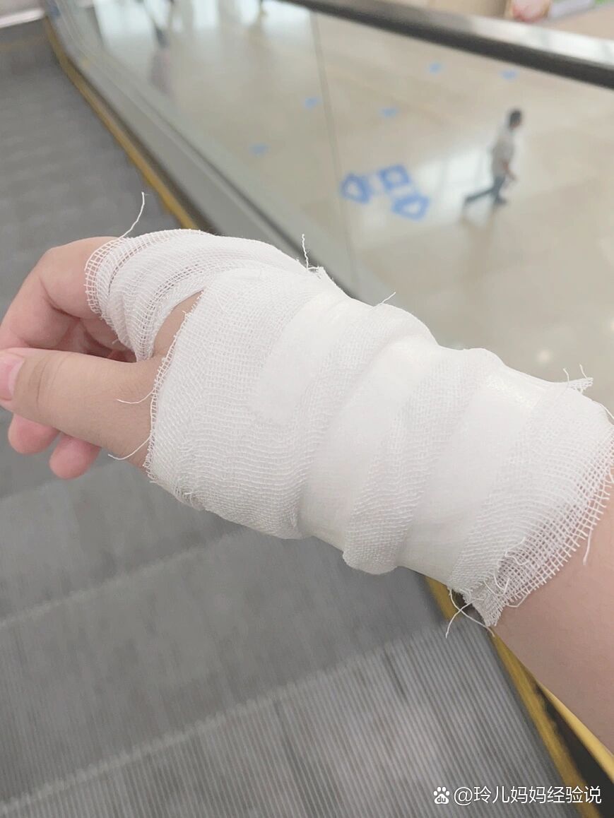 手腕三角纤维软骨损伤