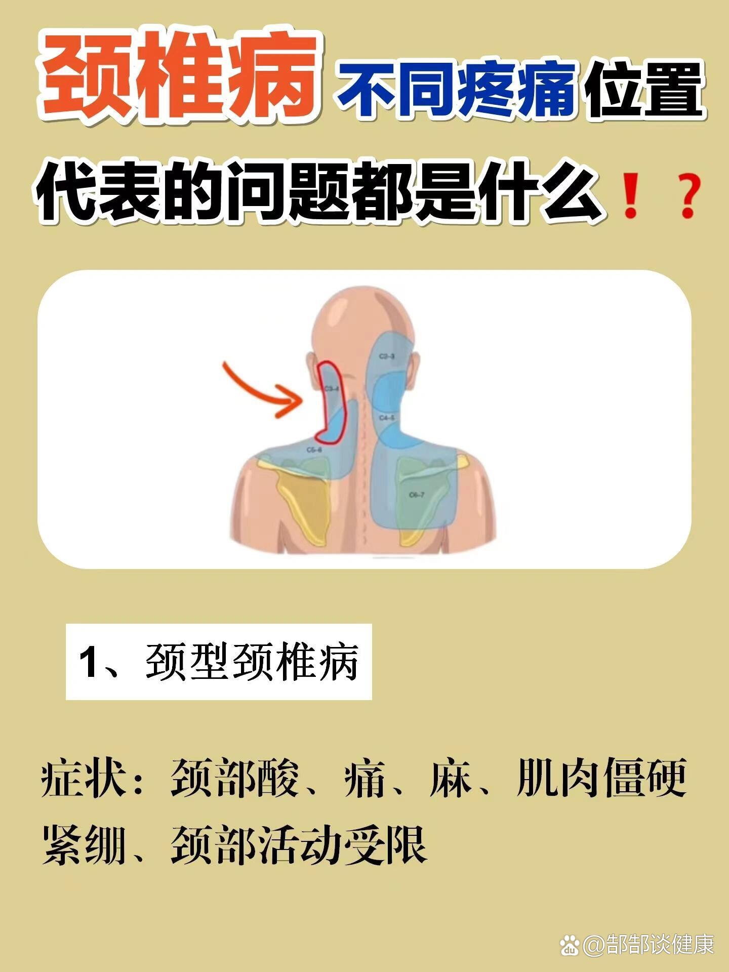 颈椎病不同位置的疼痛