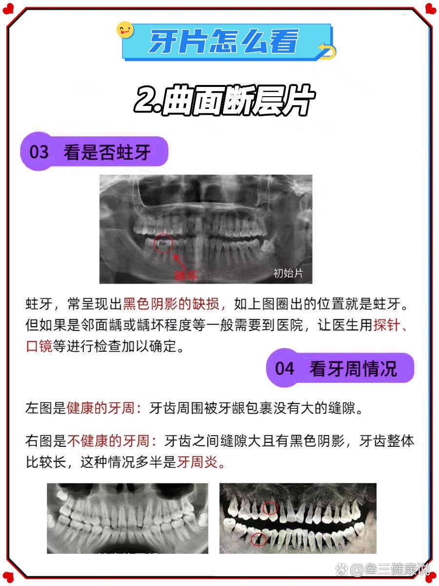 牙片怎么看?