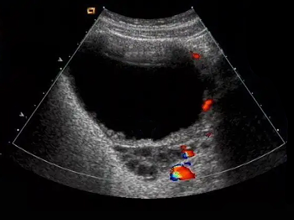 卵巢浆液性囊腺瘤给出的警示——女性无诱因阴道流血