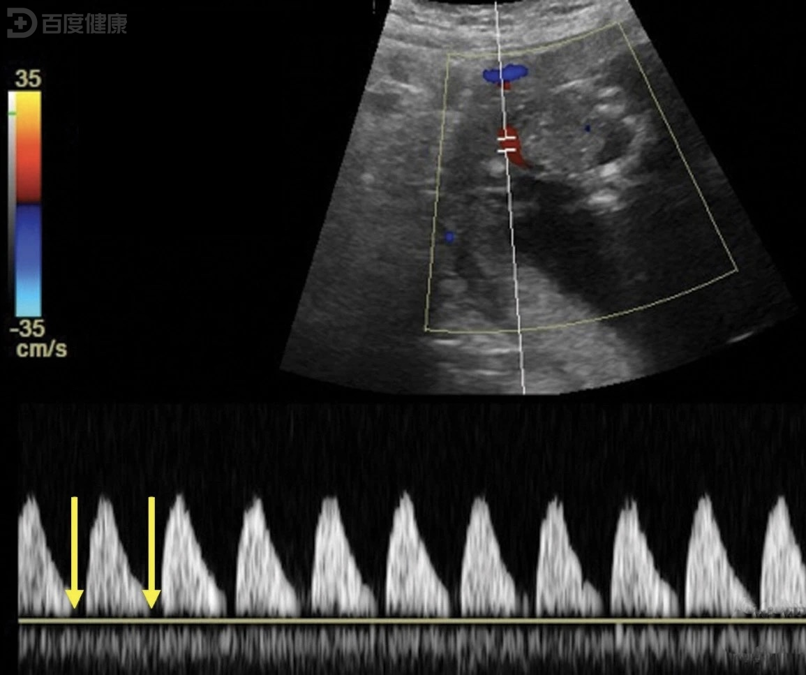 双羊膜囊单绒毛膜单卵双胎妊娠孕妇应警惕双胎输血综合征