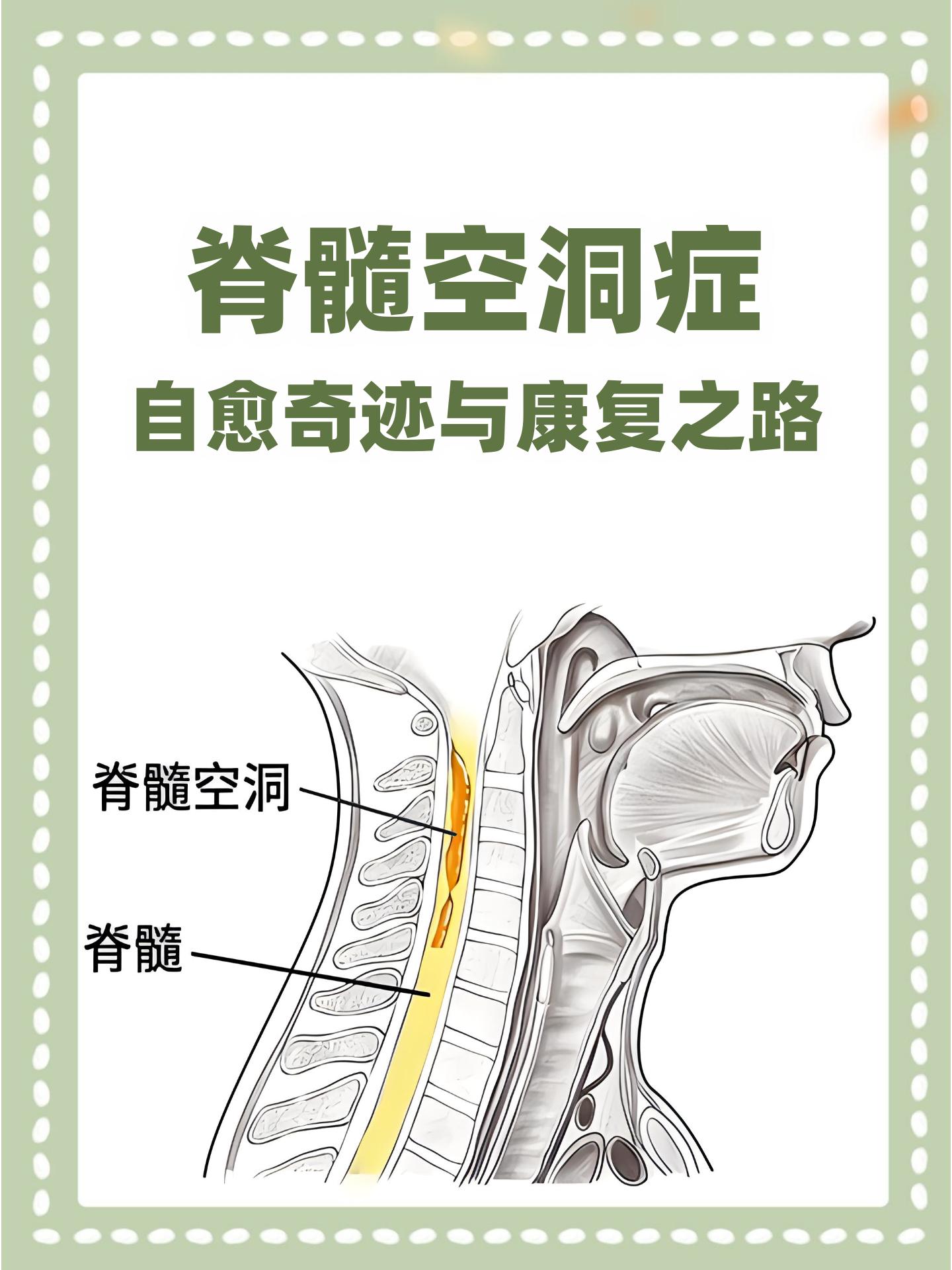 脊髓空洞病图片