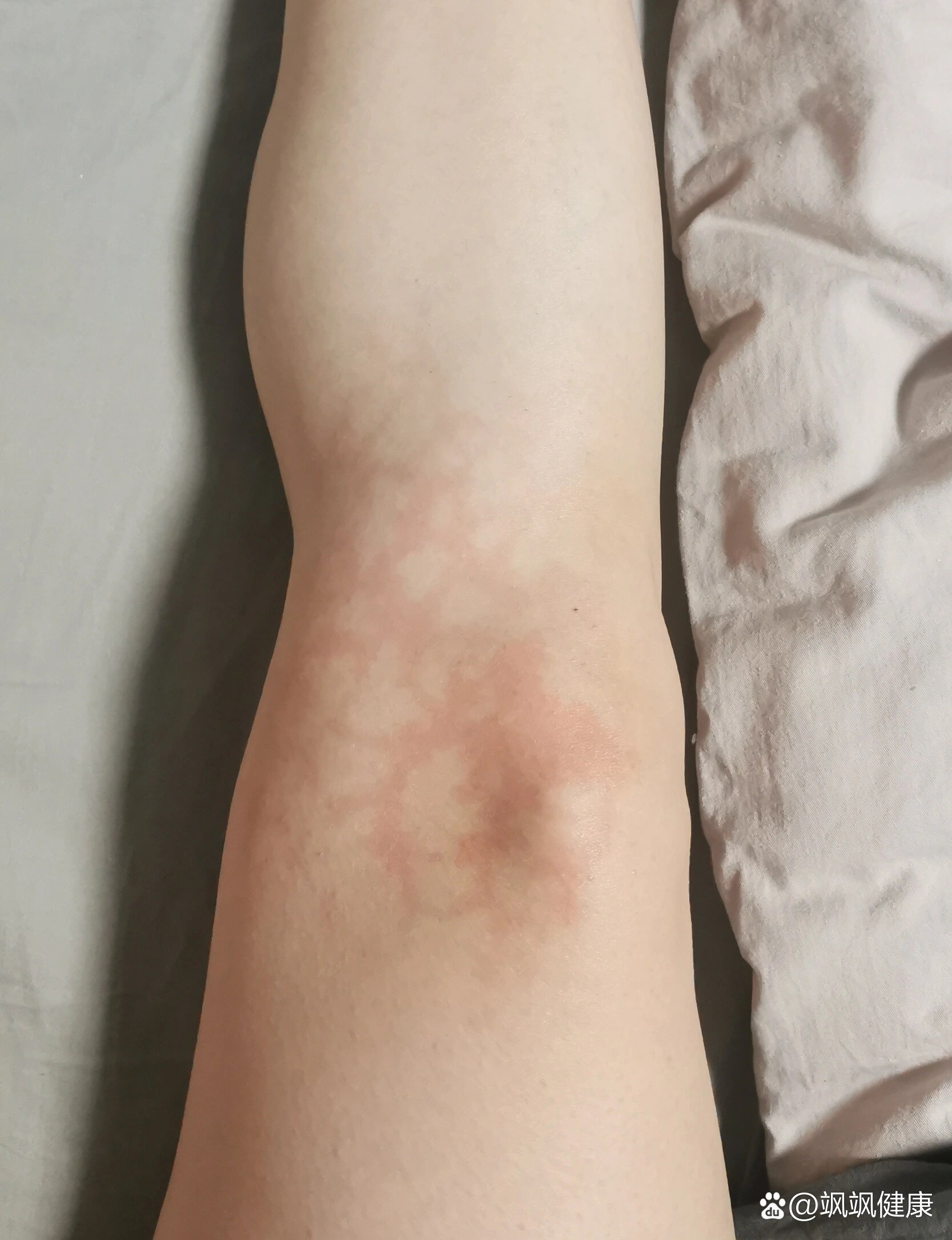 皮肤出现蜘蛛纹