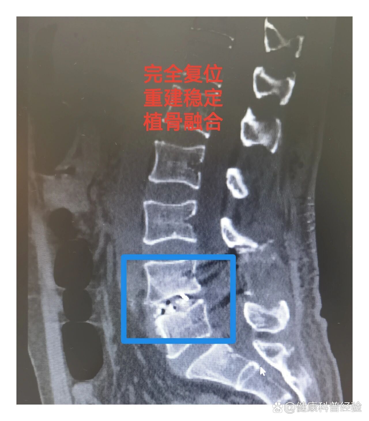 腰椎滑脱x线诊断图片