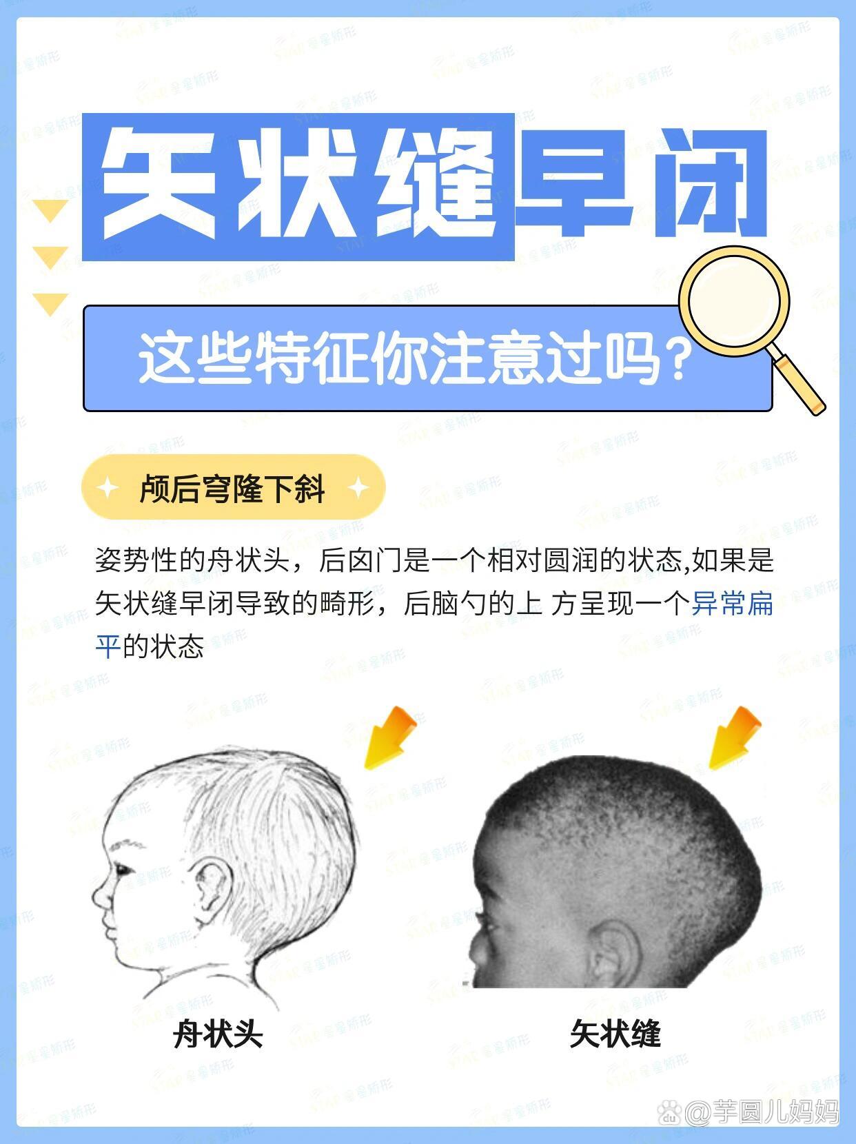 矢状缝早闭7515这些特征你注意过吗71