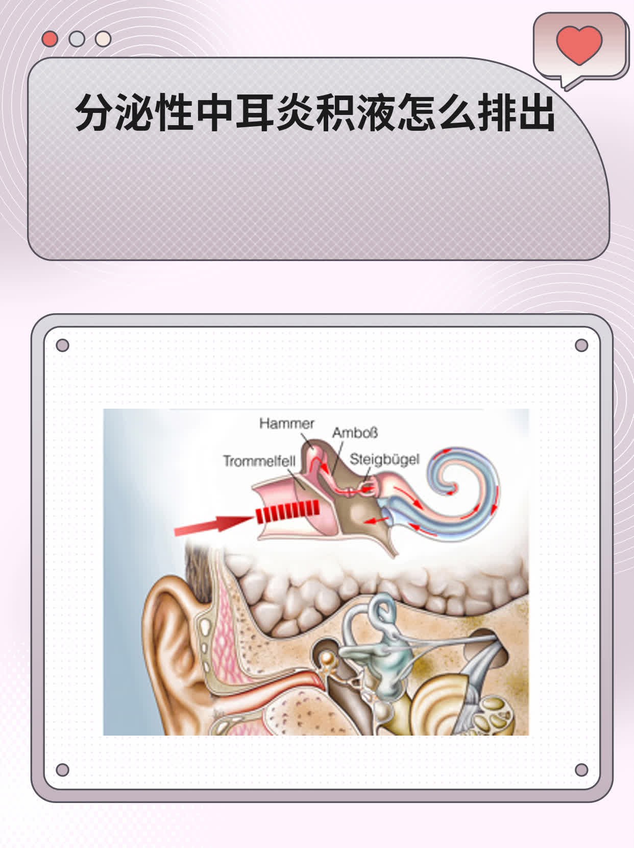 分泌性中耳炎积液怎么排出