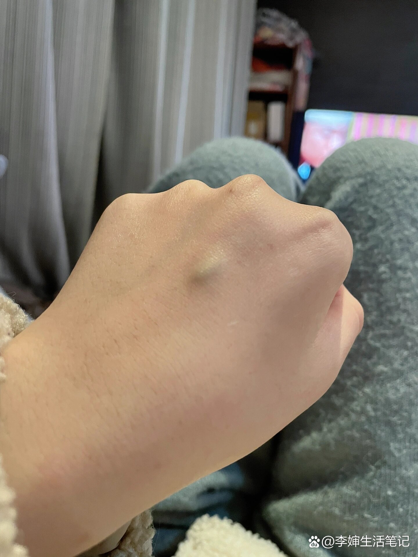 输了一两周的水,现在已经一个半月后了,血管这里有个鼓包,按着是硬的