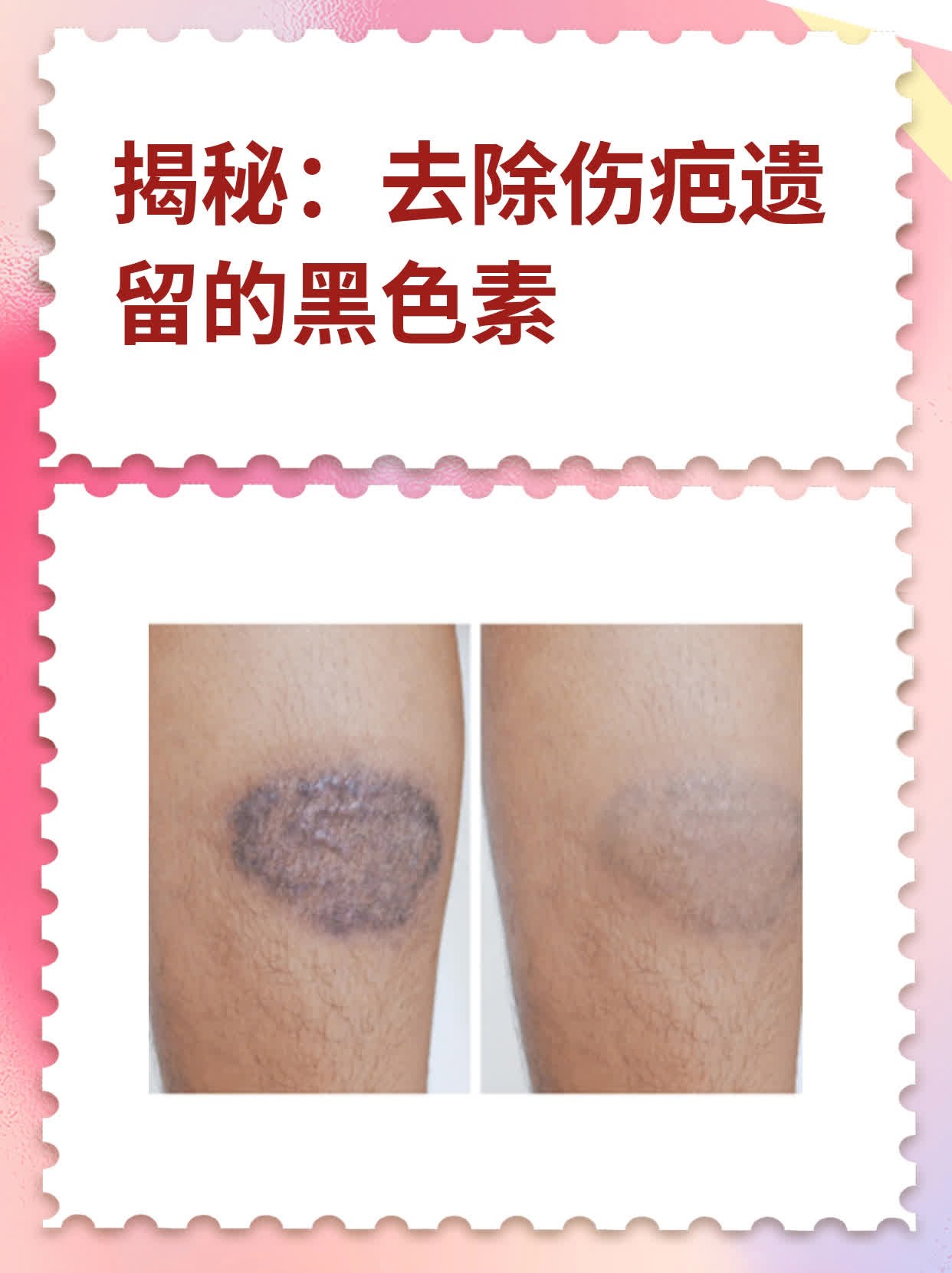 揭秘:去除伤疤遗留的黑色素