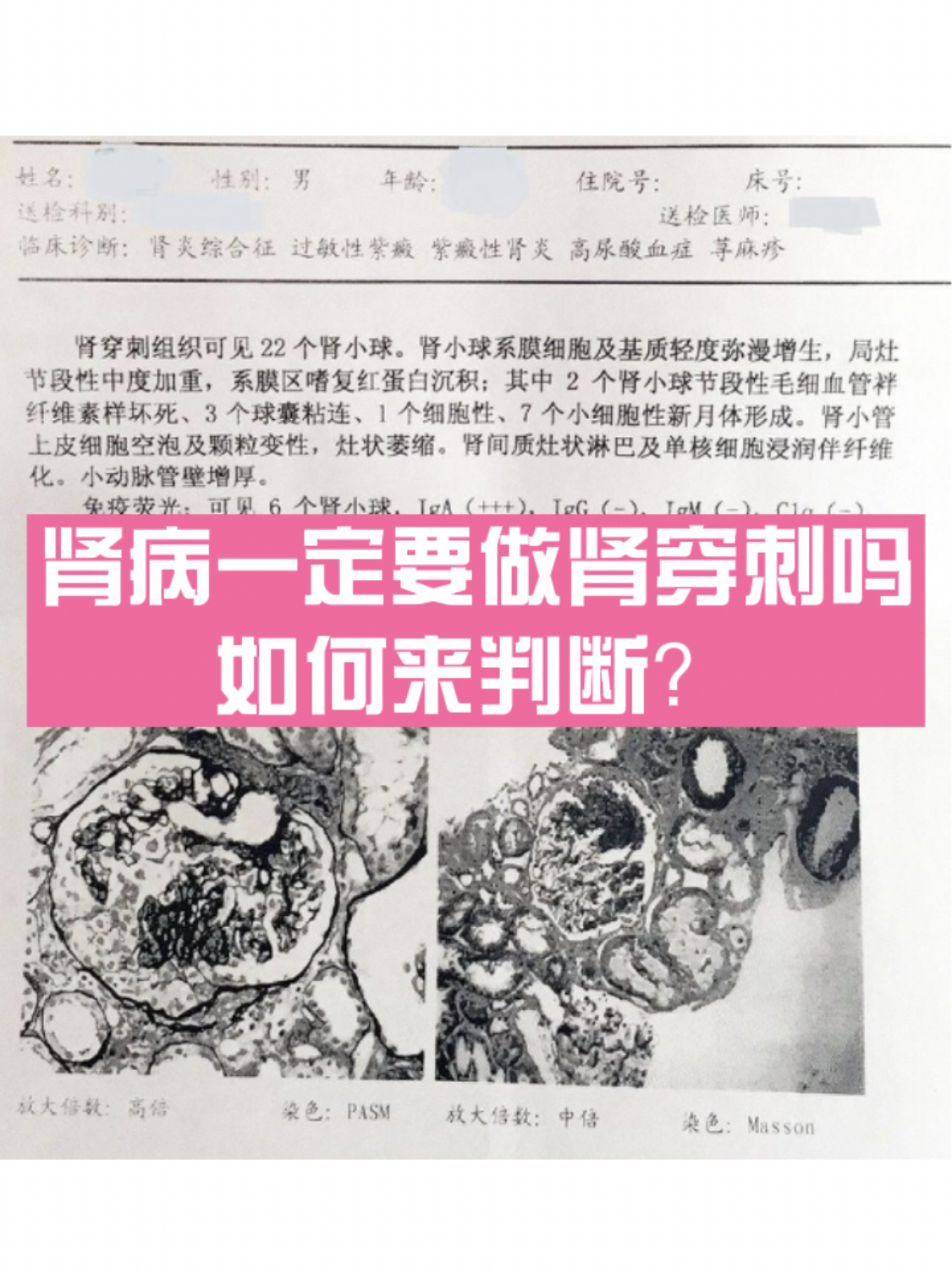 肾病一定要做肾穿刺吗?