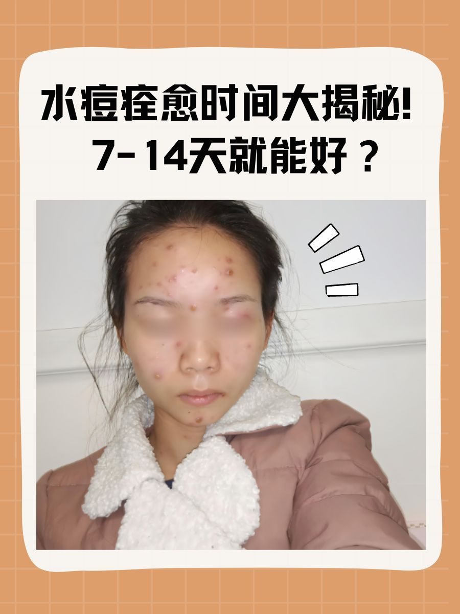 水痘痊愈时间大揭秘!7