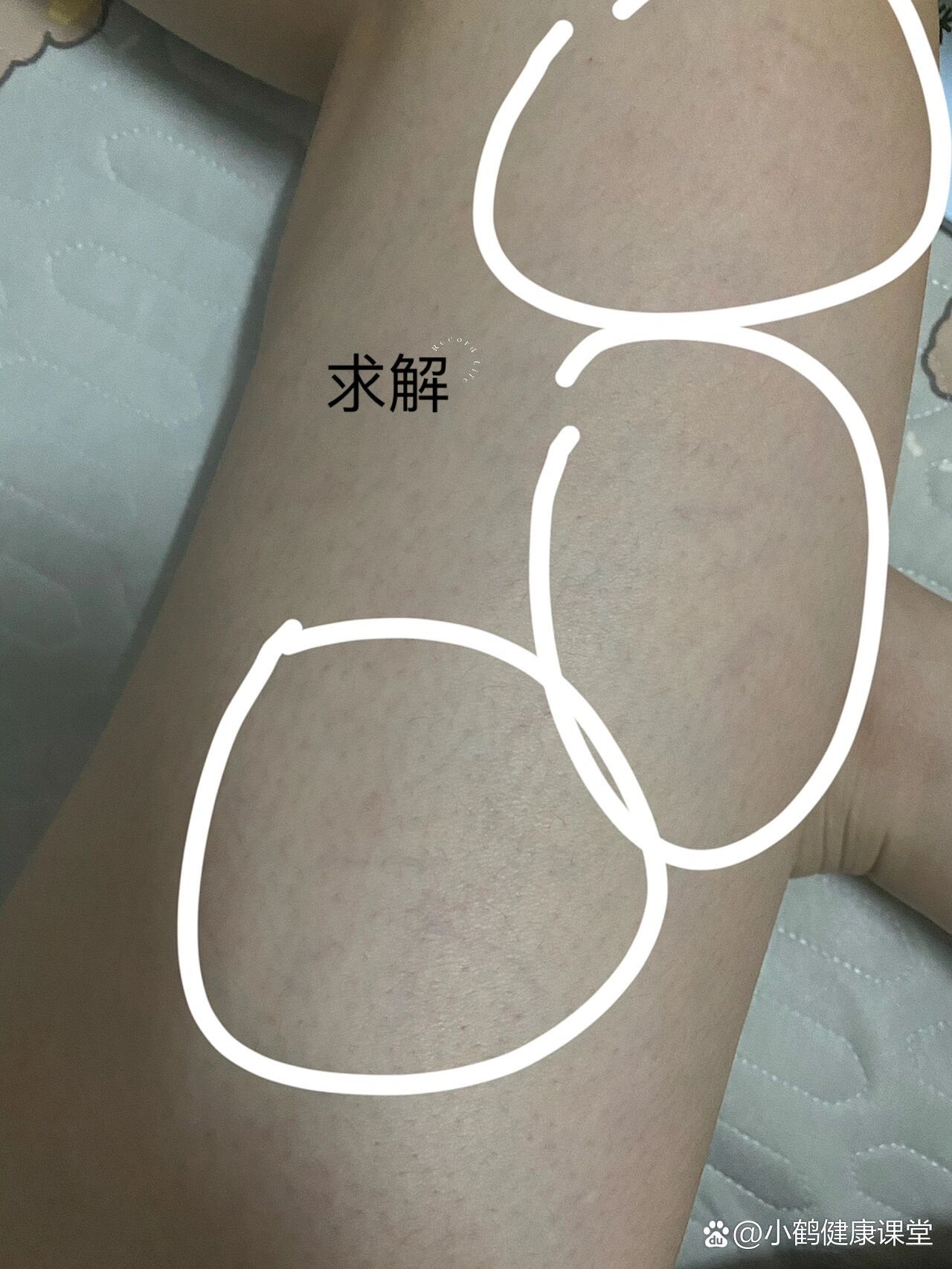 腿上出现了很多细细的紫色小血管!