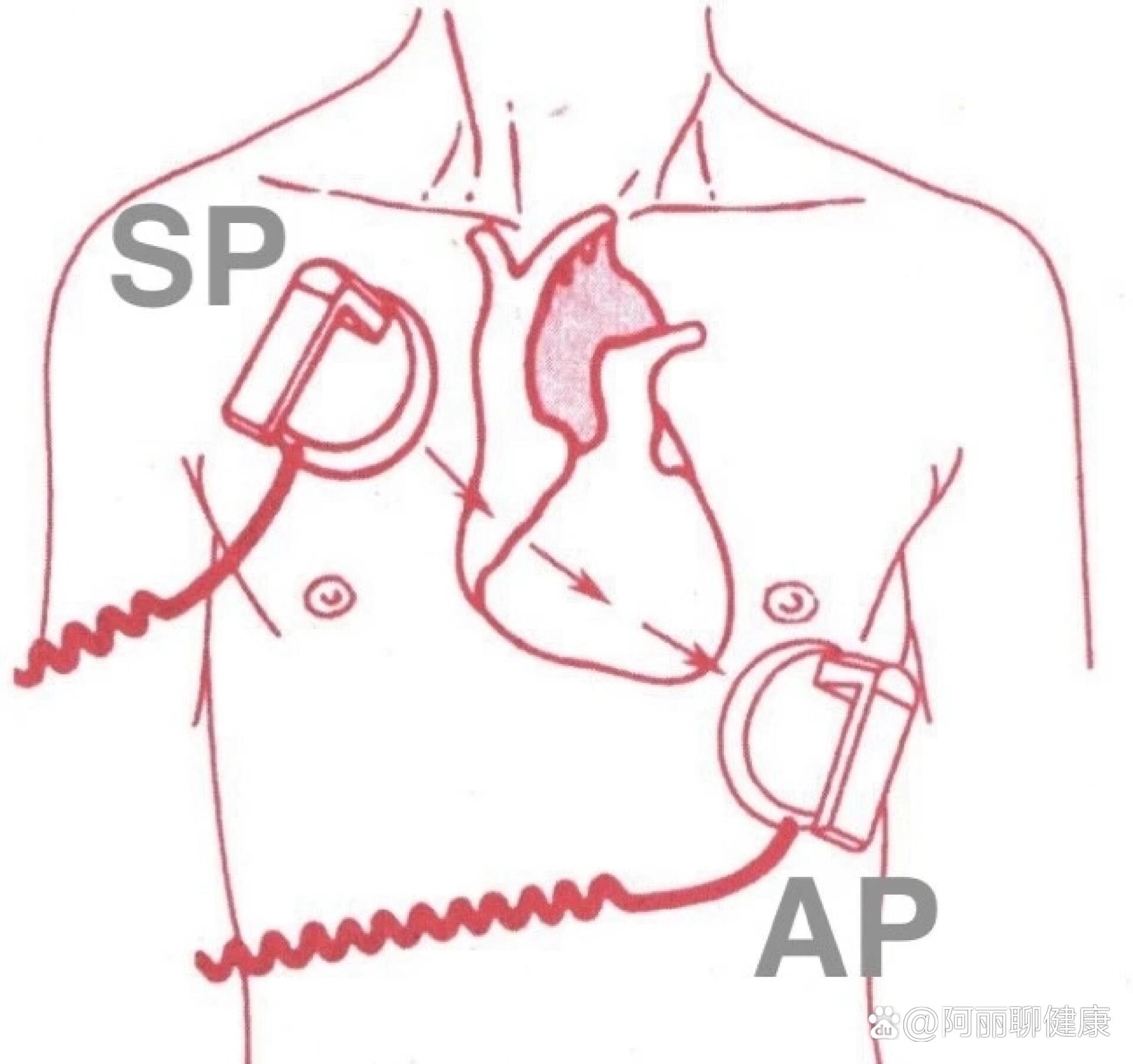 起搏器安放的位置图图片