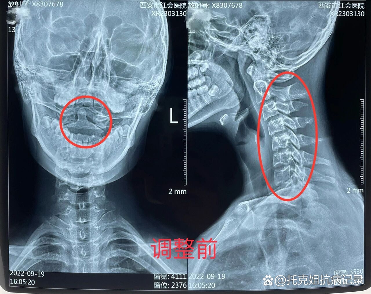 颈椎旋转活动受限,x提示寰枢关节脱位,行手法复位一周后复查,关节回位