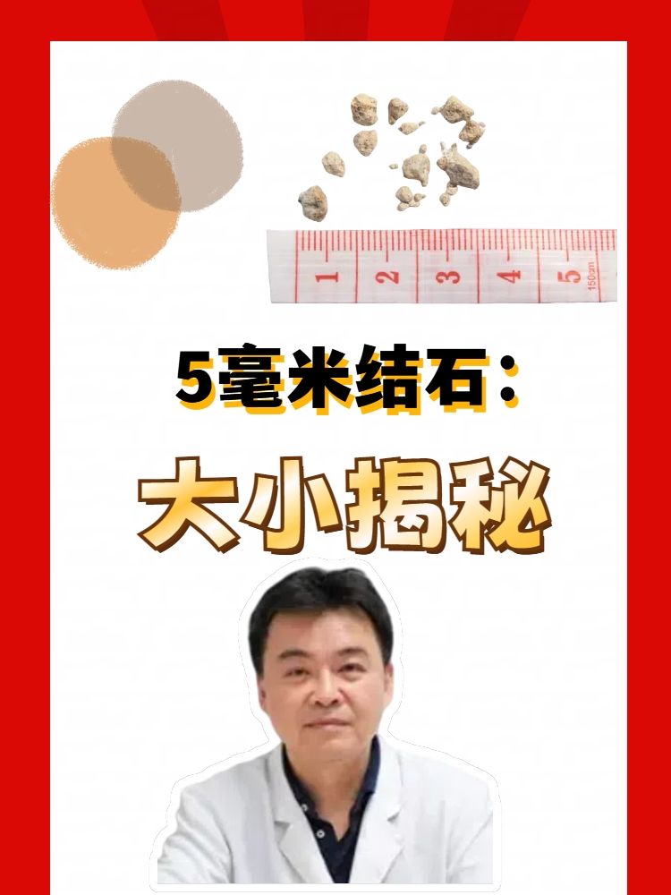 5毫米结石:大小揭秘