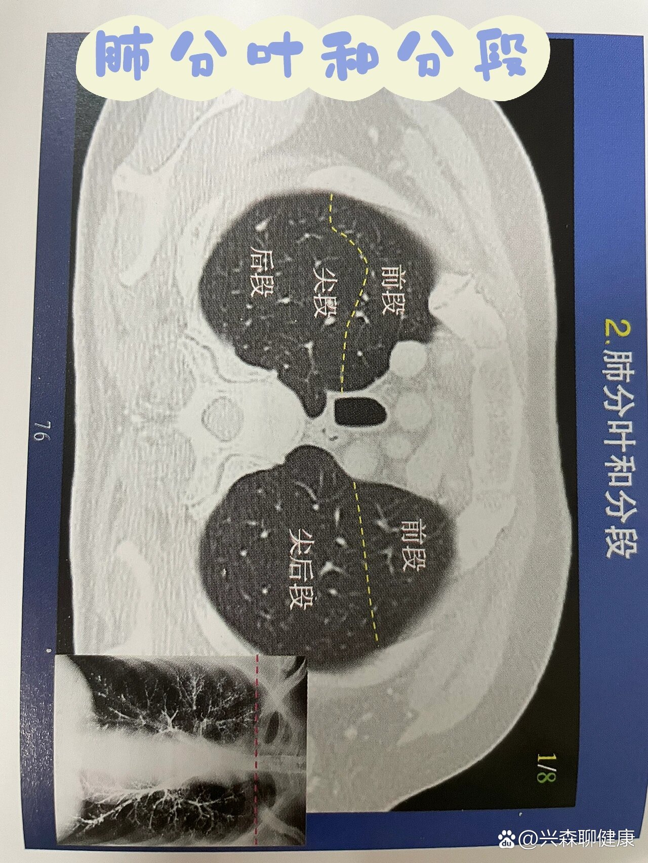 ct肺分叶分段解剖图图片