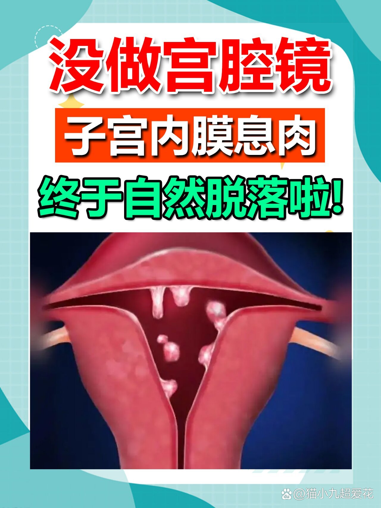 没做宫腔镜,子宫内膜息肉终于自然脱落啦!