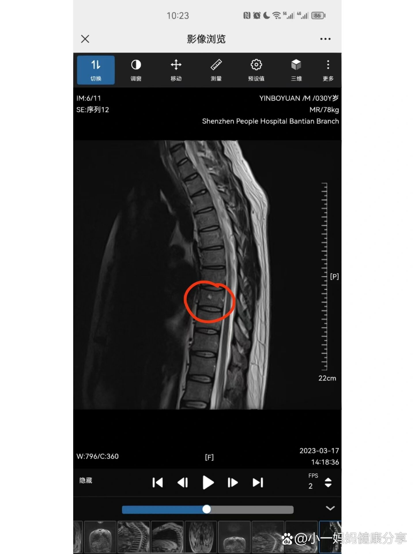  p>后背疼 mri胸椎血管瘤 br>书接上文 br>后背痛经过三次按摩理疗