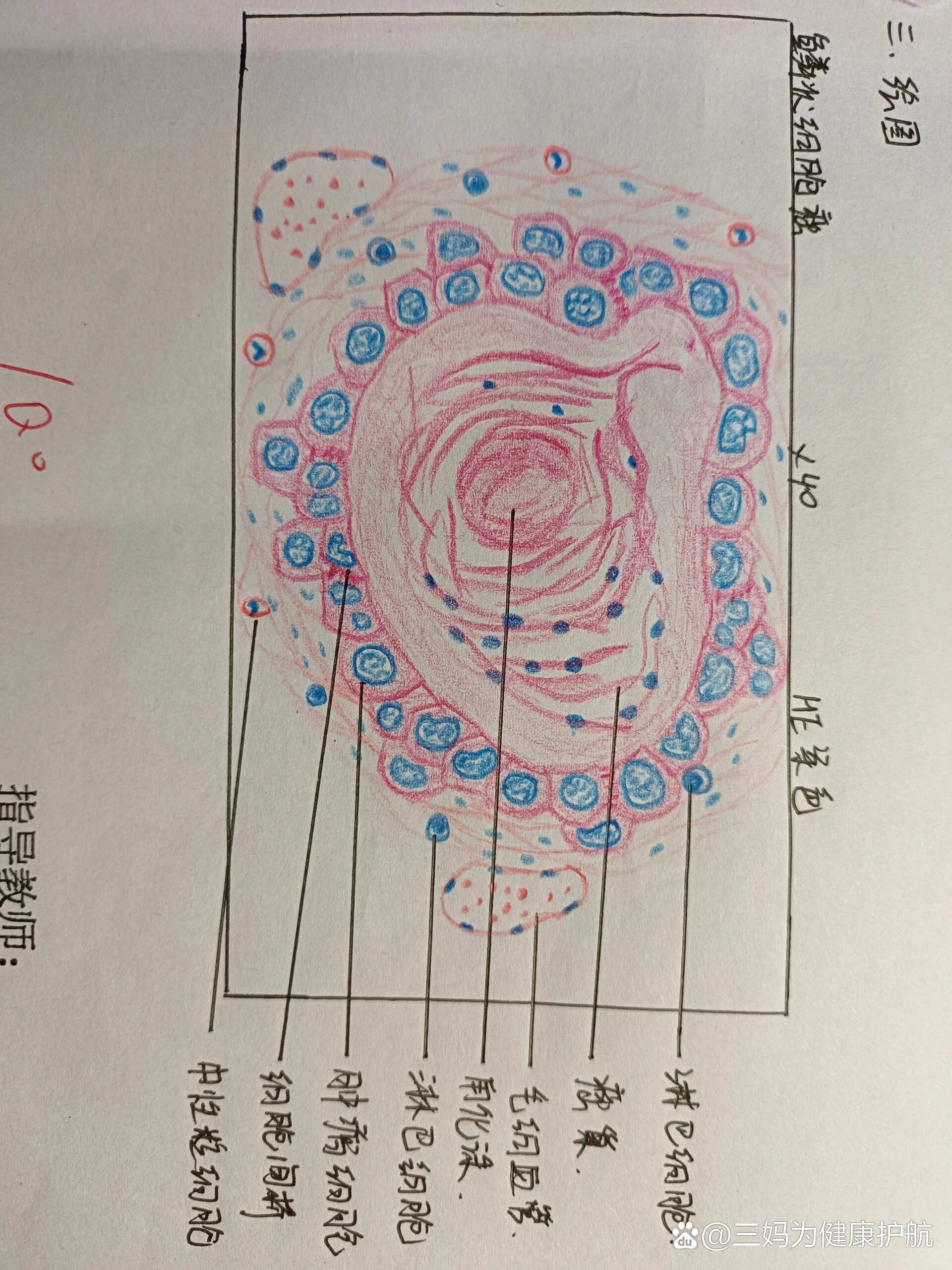 绒毛膜癌病理手绘图图片