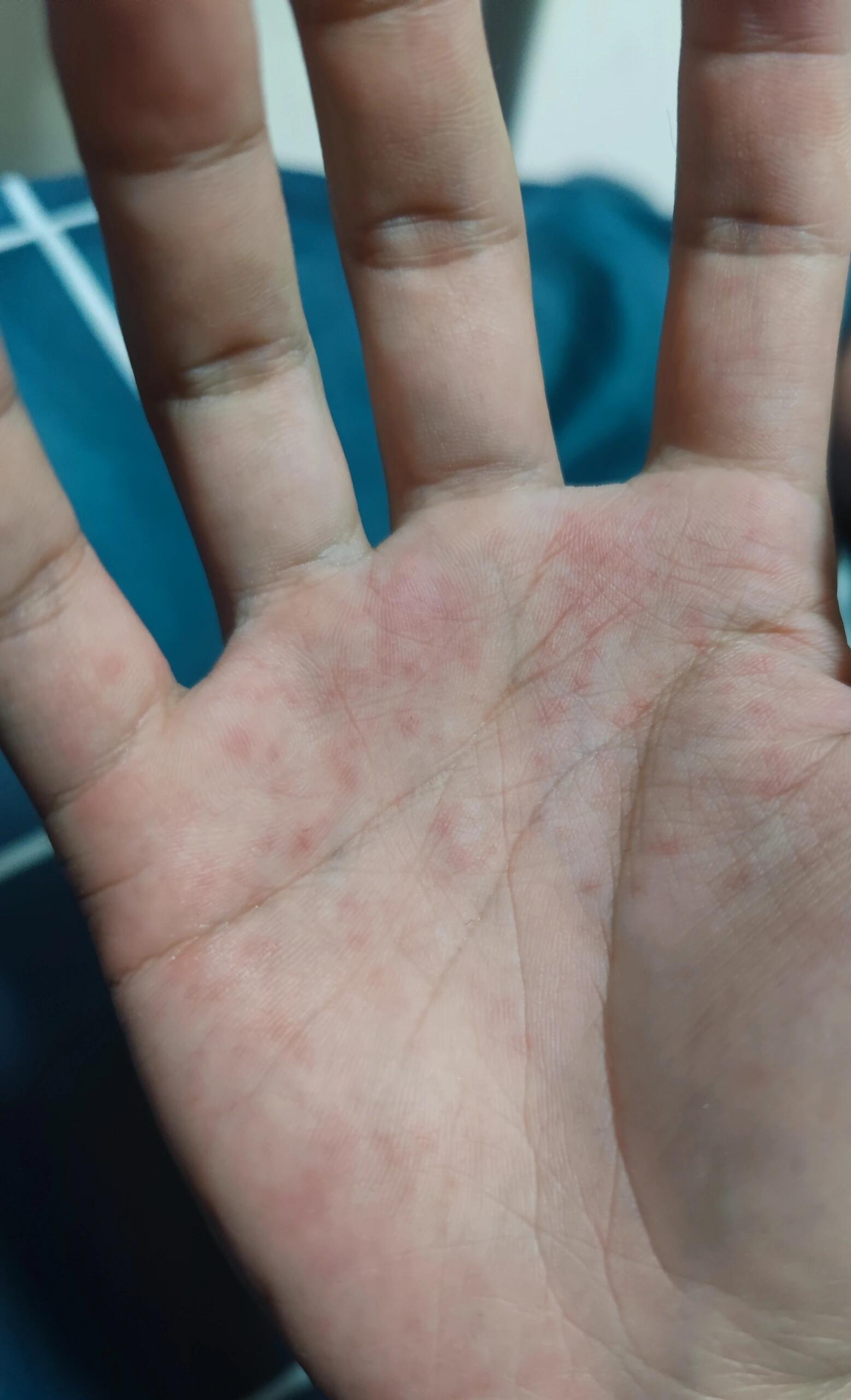 最开始手上长小红点,有点痒,用了这两个药一天就差不多好了