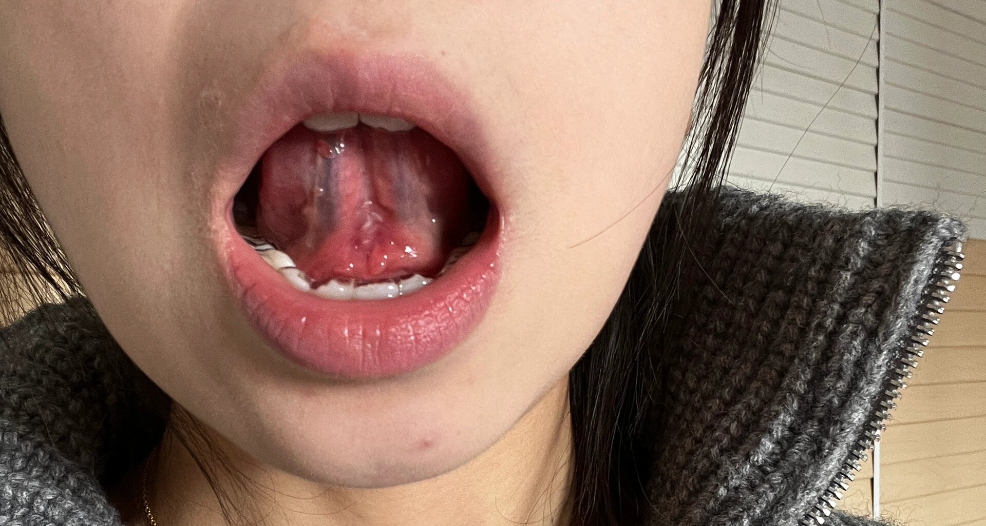 舌头根部下面疼咋回事儿