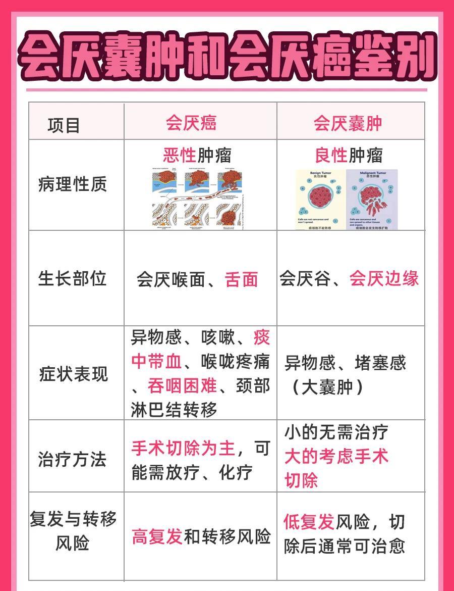 会厌囊肿与会厌癌鉴别指南