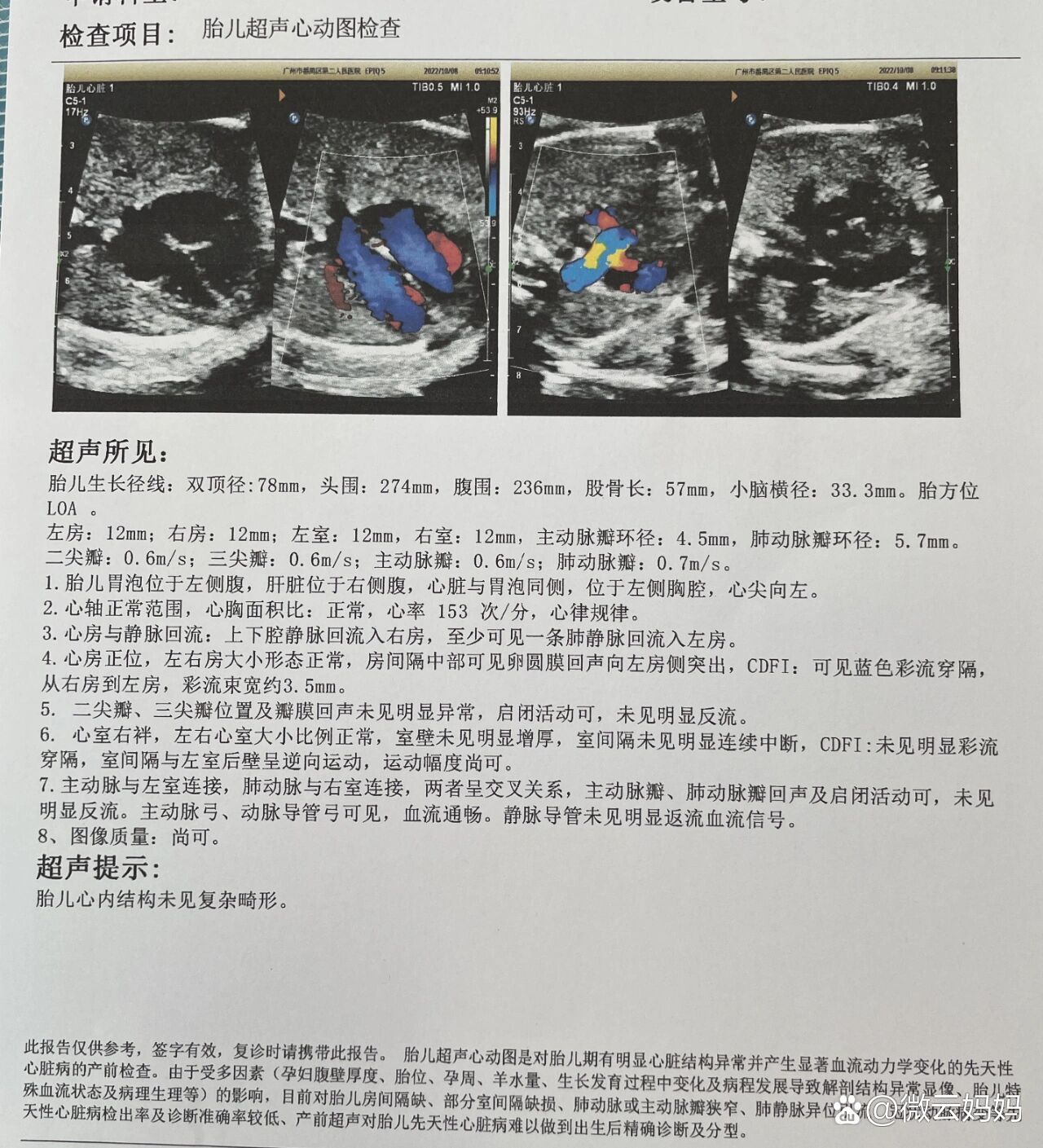 胎儿超声心动图
