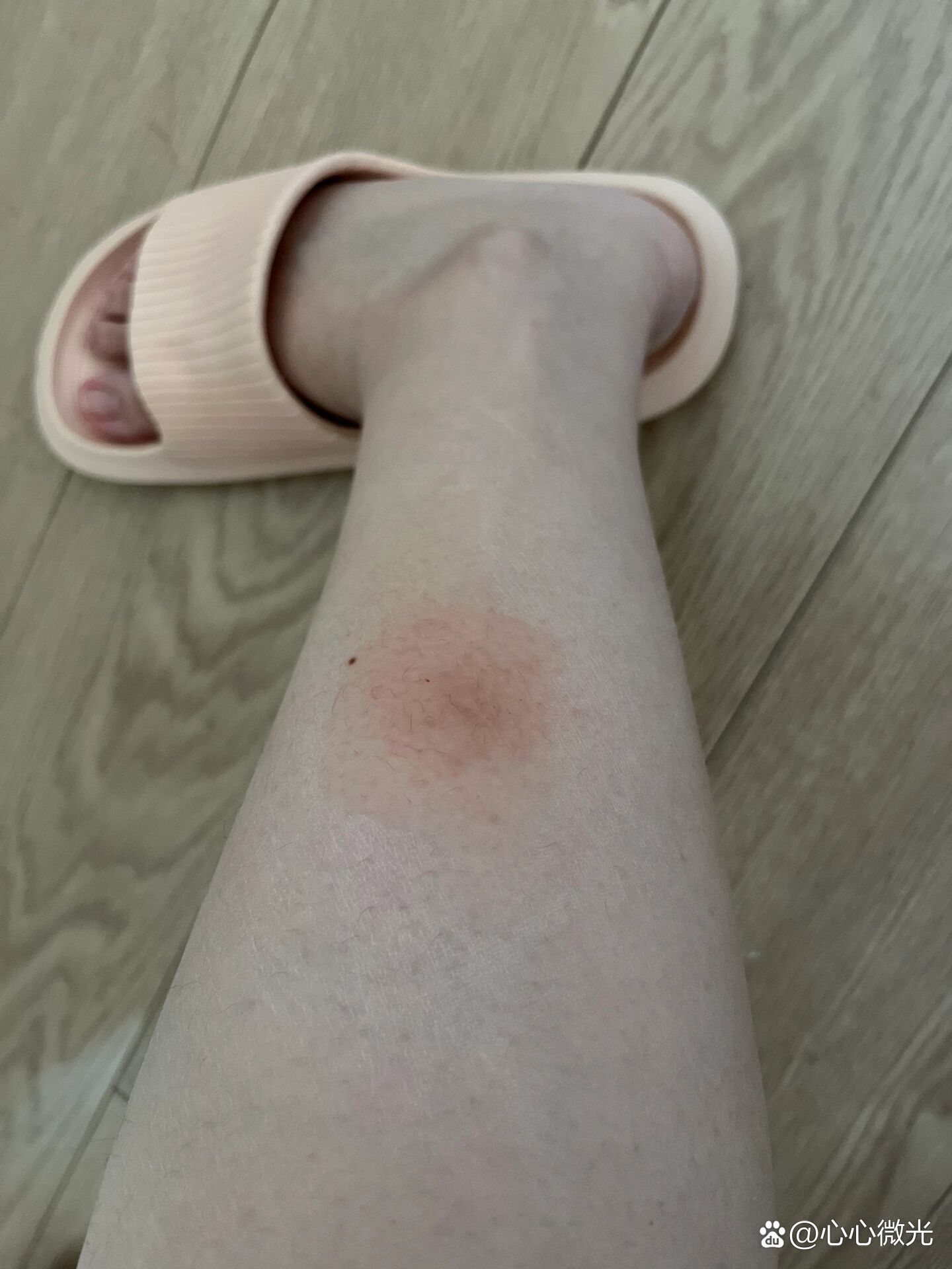 换季腿上长发痒的红疙瘩