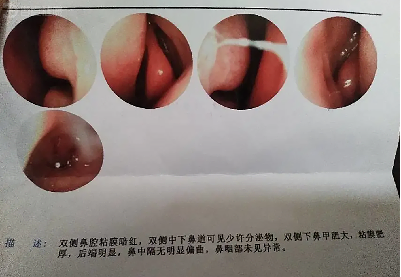 更年期竟然会引起萎缩性鼻炎