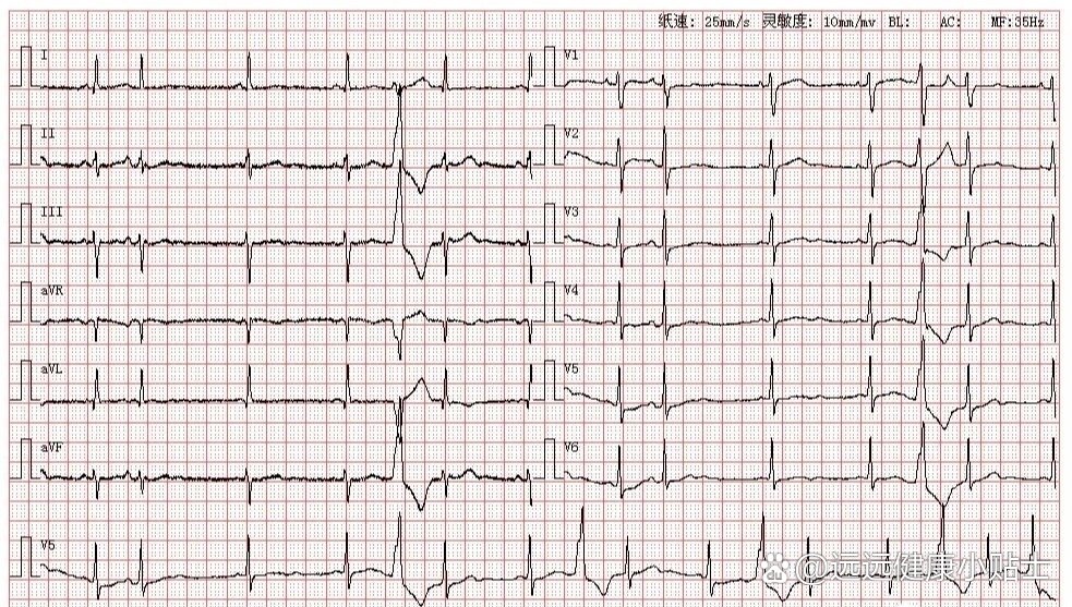 室性早搏典型心电图图片