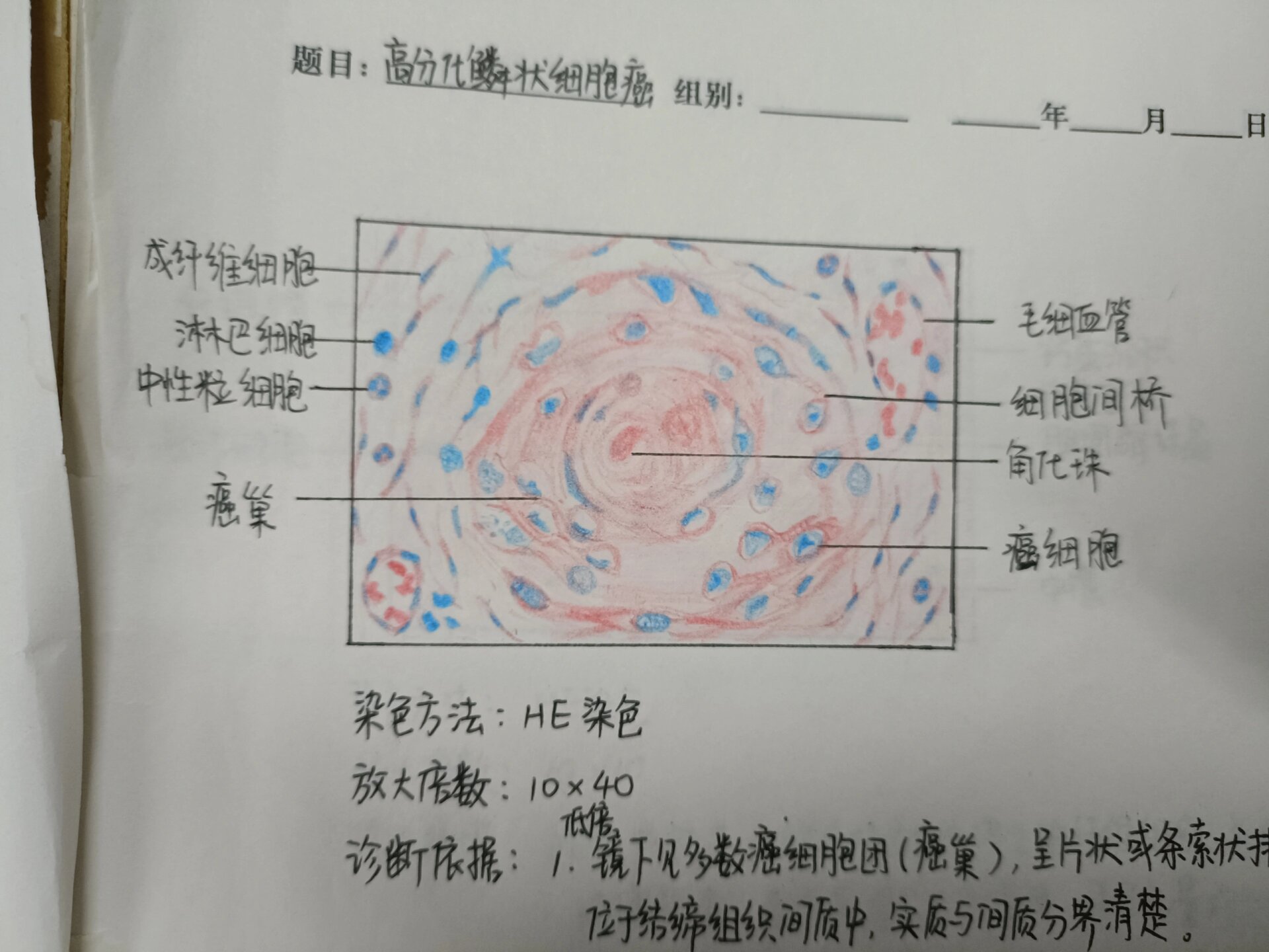 医学生绘图高分化鳞状细胞癌