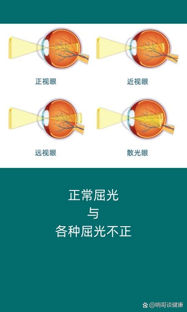 屈光,就是"曲折光线"的意思