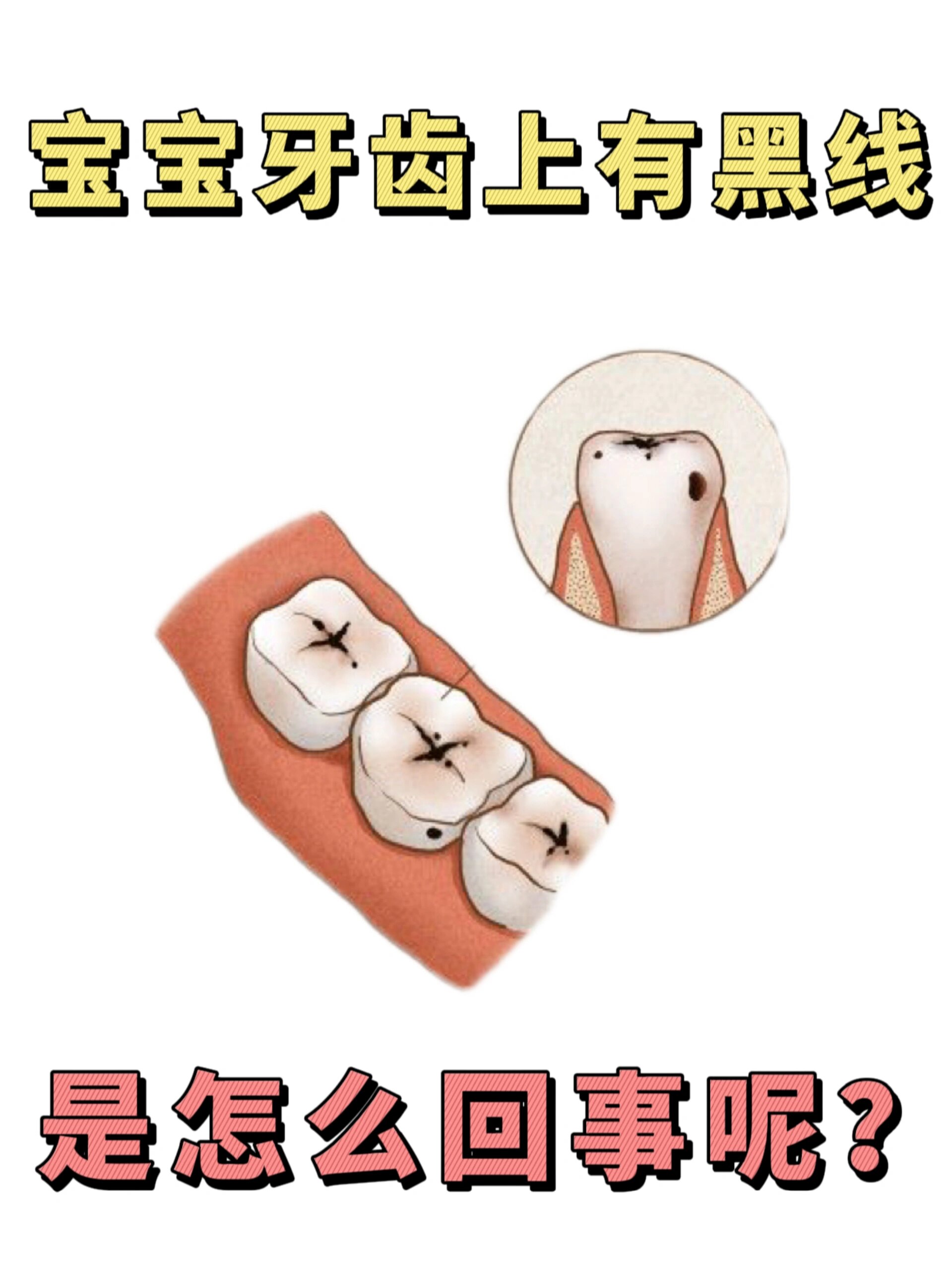 小朋友牙齿上有黑线,黑点怎么回事呢?