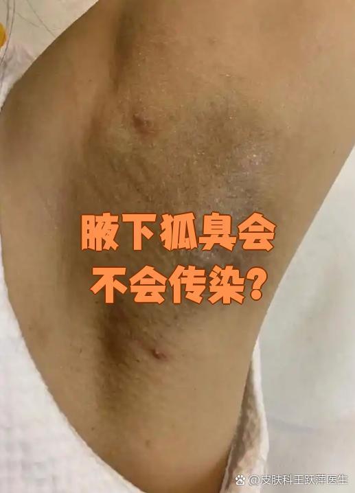 腋下狐臭会不会传染？