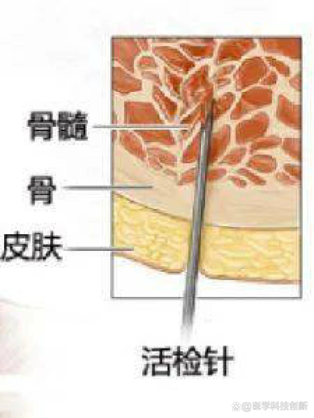 什么情况下需要做骨穿?