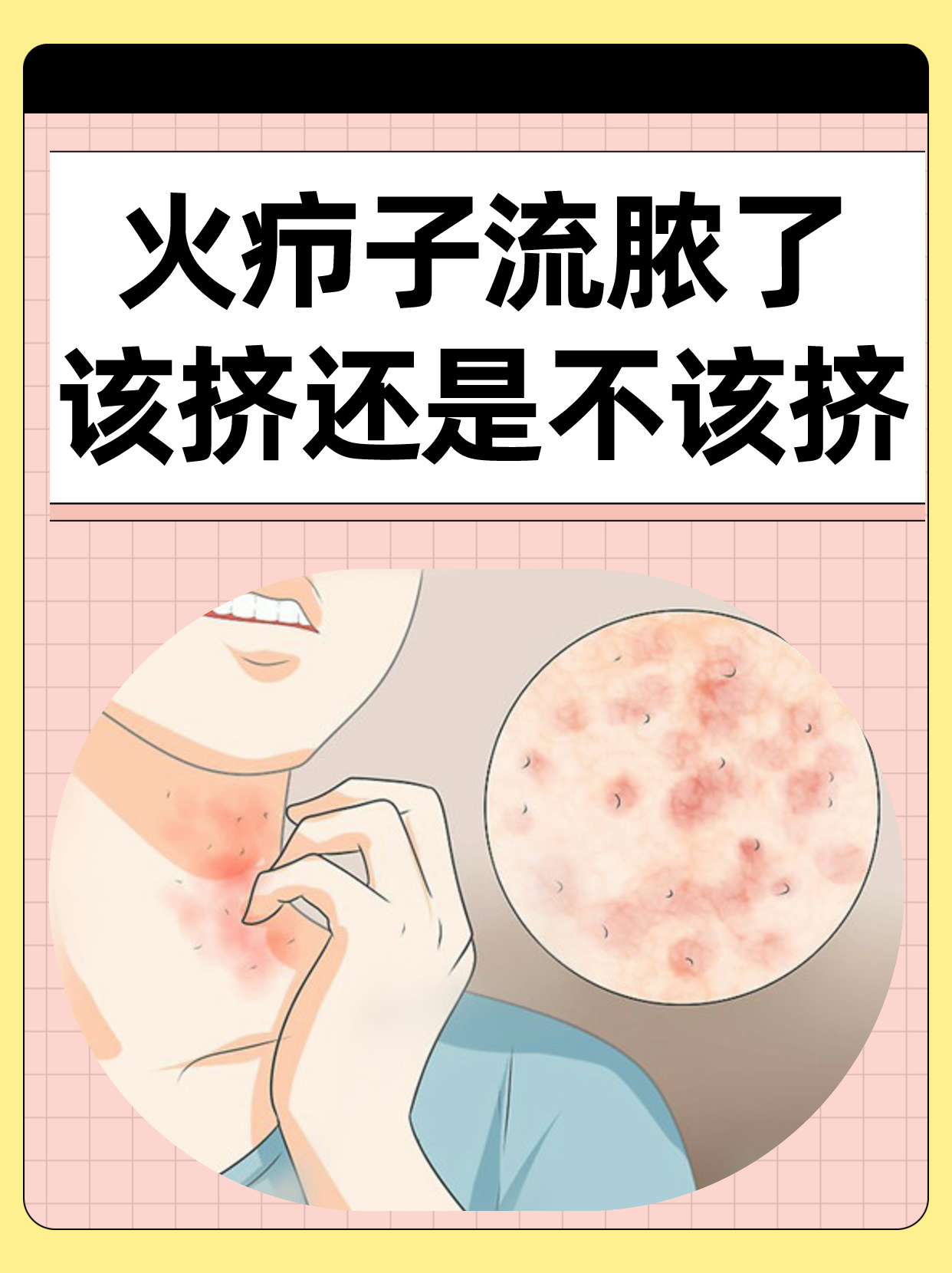 火疖子流脓了,该挤还是不该挤?