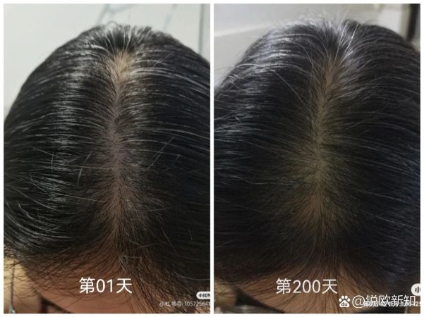 梳头生发200天对比！