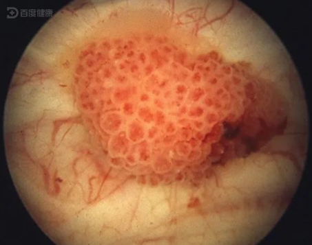 膀胱肿瘤血尿图片